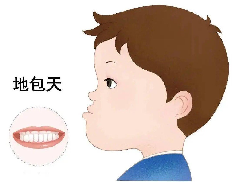地包天不止影响颜值!重庆仁品医院口腔科带你正确认识地包天
