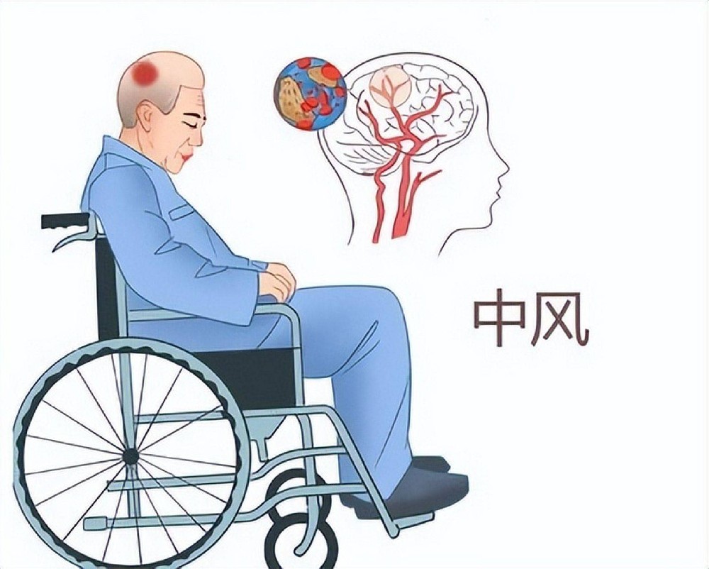 脑中风后康复≠按摩理疗！重庆仁品医院带你重新认识康复