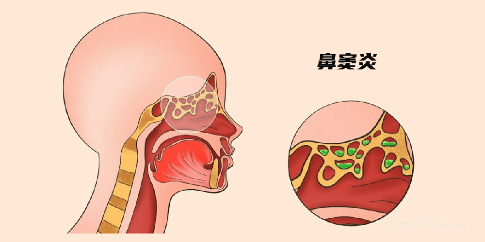 四对鼻窦，四种疼痛对照指南(附缓解方向)|重庆仁品医院科普