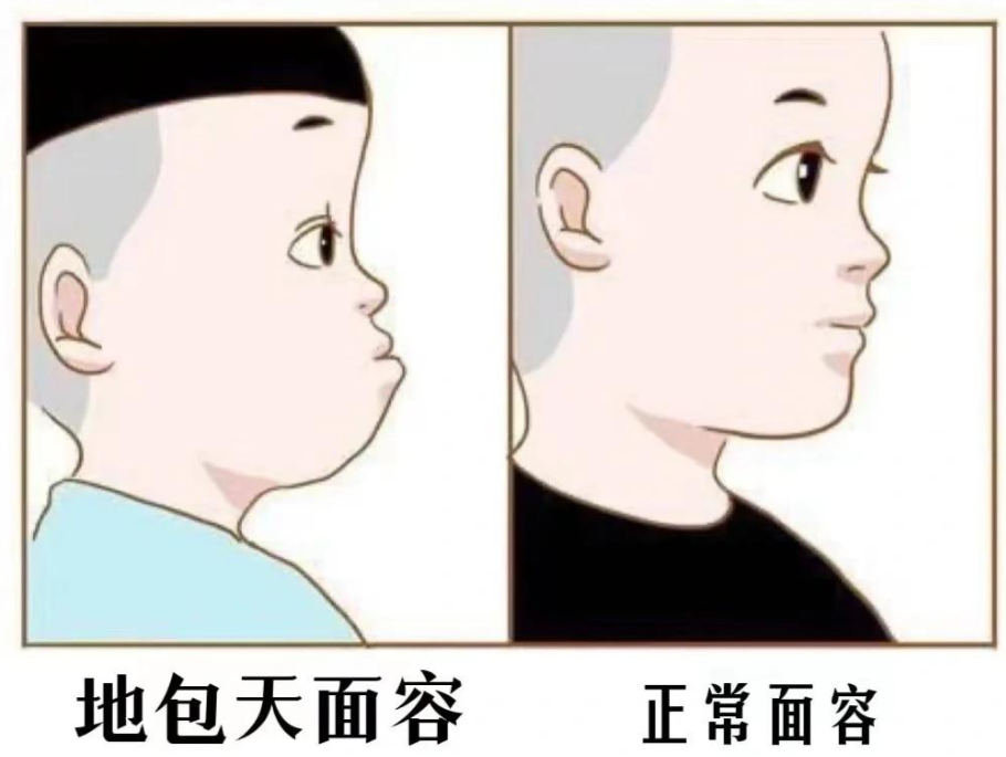 地包天别拖延矫正!重庆仁品医院口腔科：认清危害与干预时机