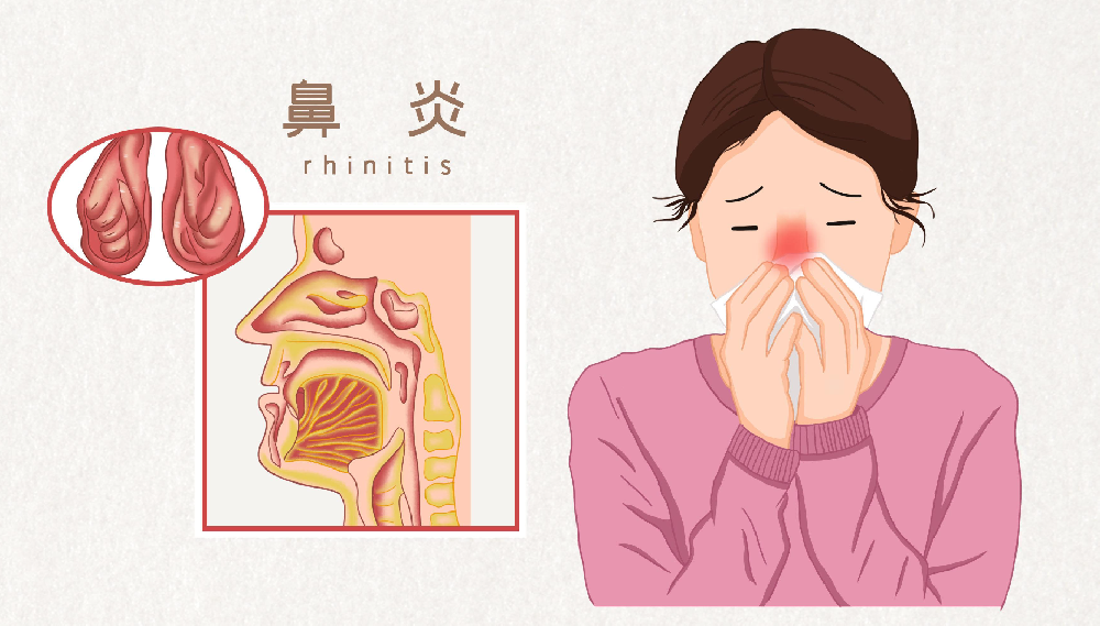 重庆仁品医院一分钟自测：你的鼻炎严重程度到哪一级了?