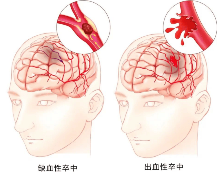 每28秒就有1人因脑卒中离世|重庆仁品医院：康复治疗不容忽视
