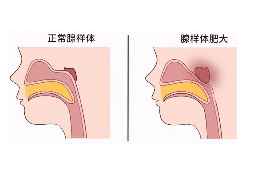 儿童腺样体肥大易拖累发育!中医分阶段养护思路