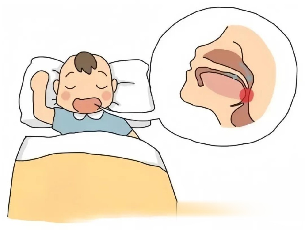 儿童腺样体肥大会有哪些影响?家长需要了解的几件事
