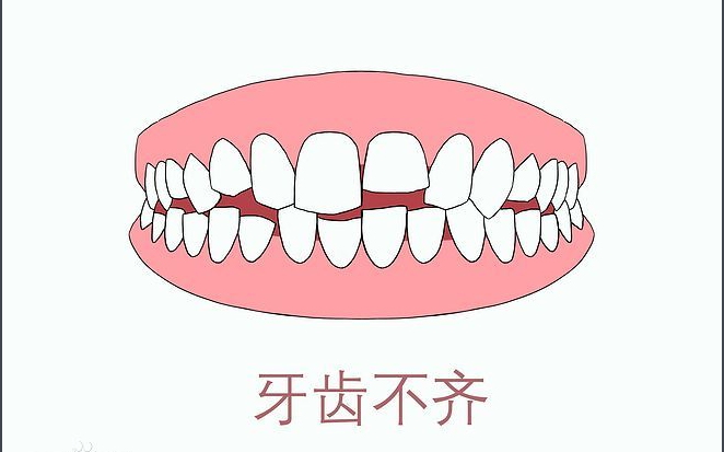牙列不齐不只是“不好看”，这些健康隐患值得关注|重庆仁品医院科普