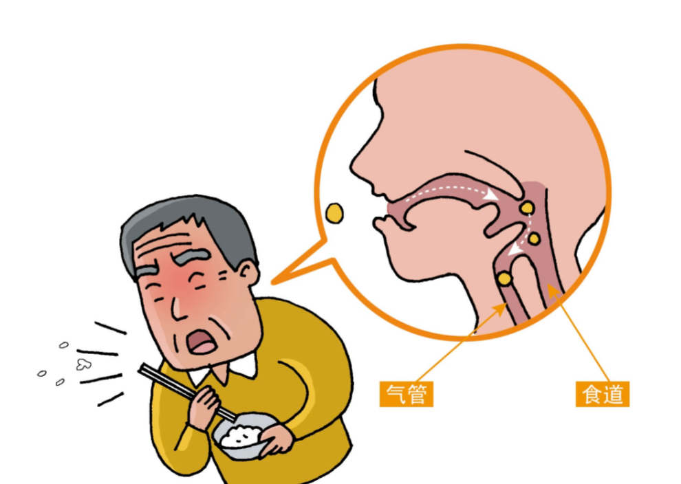 中风后吃饭就呛?重庆仁品这项无创神经激活手法,帮上百位吞咽障碍患者安全进食