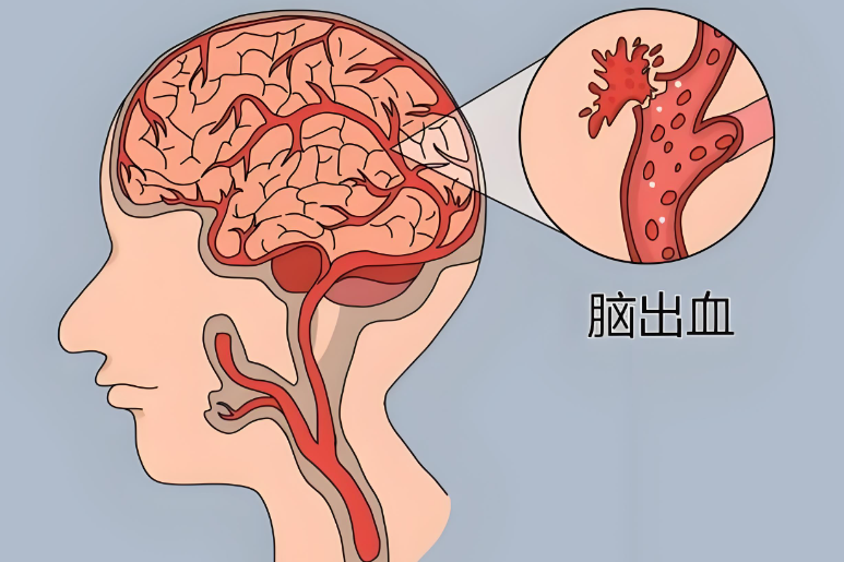 高血压脑出血后这5个后遗症最磨人,重庆仁品医院:康复不能只盯着肢体练