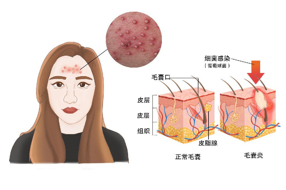 毛囊炎反复发作，根源可能不在“皮肤表面”——重庆仁品医院