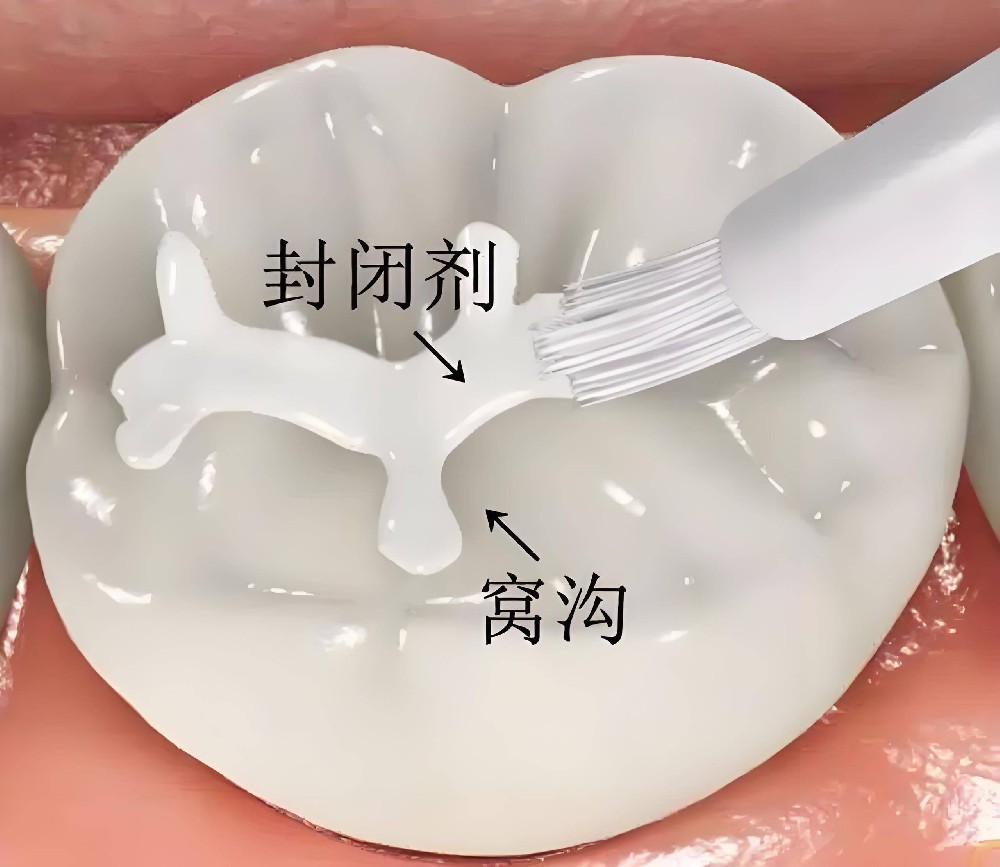 涂氟加窝沟，才是儿童防蛀的“黄金组合”——重庆仁品医院